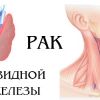 Операции опухолей щитовидной железы